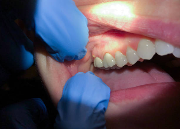 Best Emergency Denture Repair in Ormond By The Sea, FL